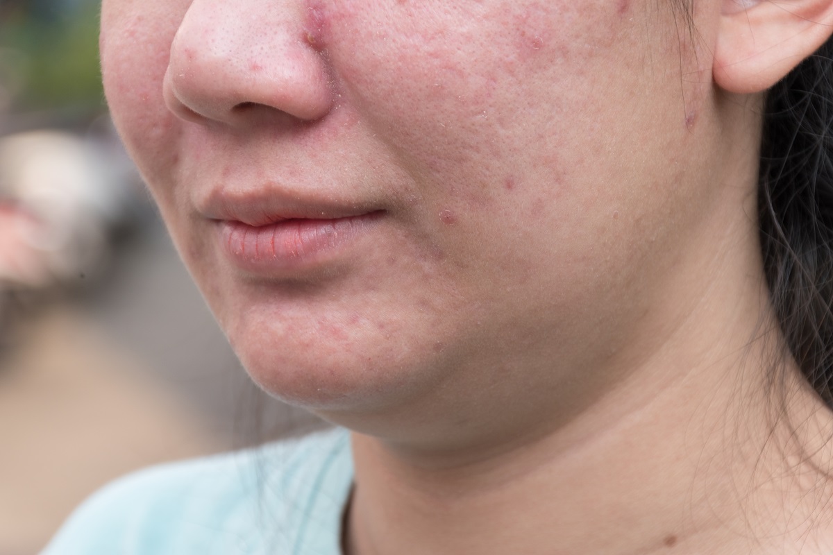 Fights acne outbreaks