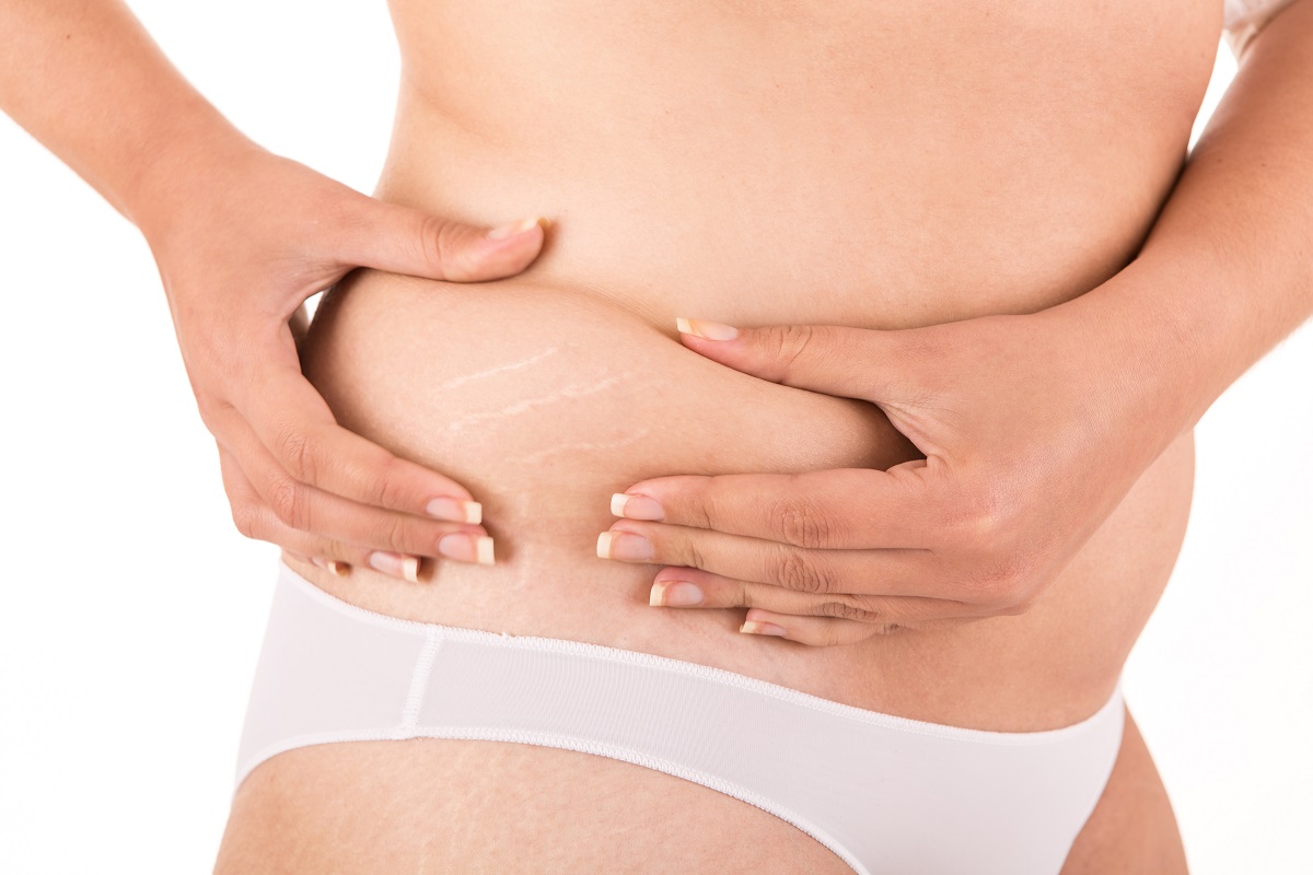 4 Easy Remedies for Stretch Marks